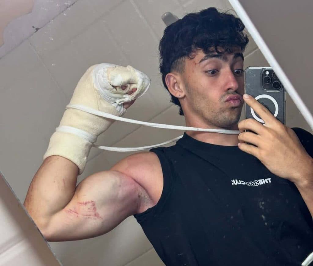 Influencer fitness pierde dos dedos en trágico accidente